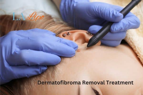 Dermatofibroma Removal Treatment Ashbourne