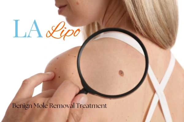 Why getting moles removed Ashbourne can boost your confidence!