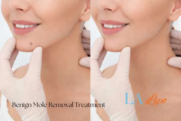 Woman's before and after results of being moles removal treatment Ashbourne
