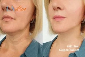 hi-fu for wrinkles Ashbourne before and after results