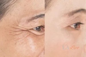 Before and after results of woman - HI-fu wrinkles reduction treatment Ashbourne