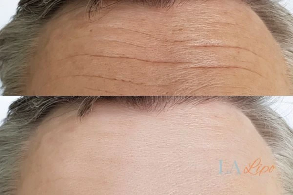 results of HIFU Ashbourne on mans forehead to help reduce lines and wrinkles