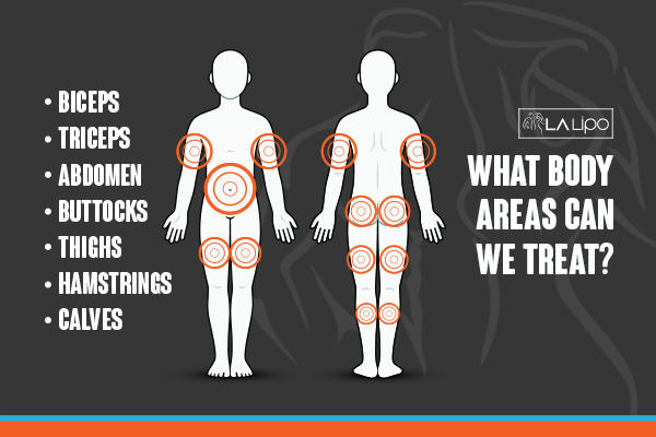 Graphic to show areas you can have LA-EMS Body Sculpting Ashbourne treatment.