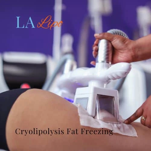fat freezing - Cryolipolysis Ashbourne