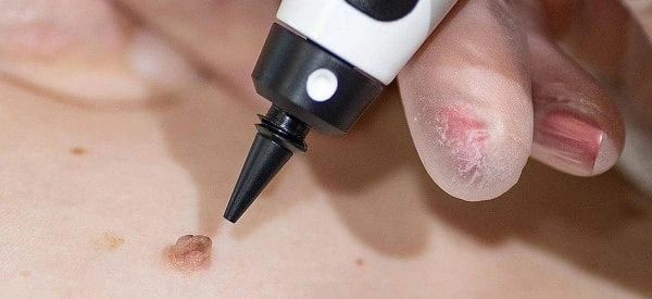 skin tag removal using cryopen Ashbourne