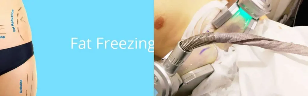 Fat freezing Ashbourne on multiple areas of the body
