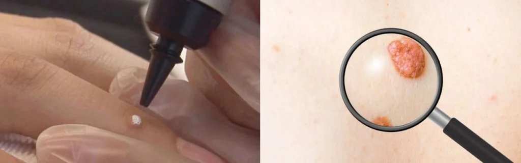 Person getting moles removed with cryopen Ashbourne