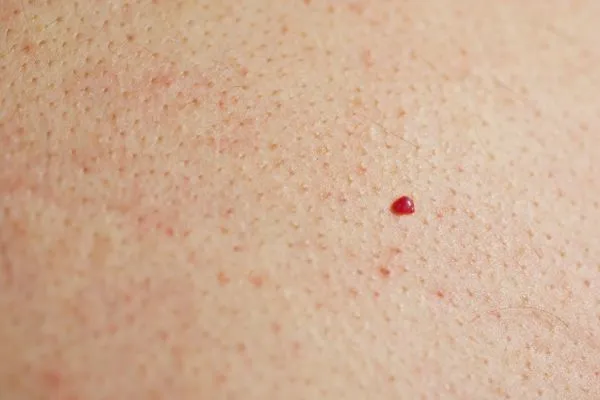 close up of a cherry angioma Ashbourne
