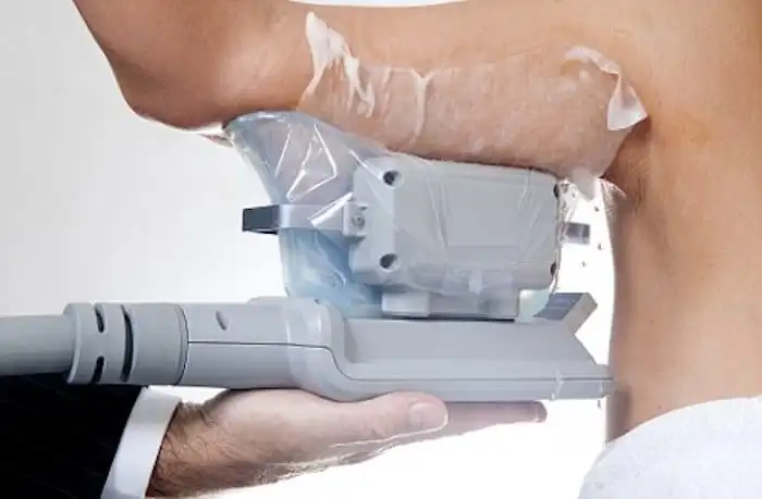 Picture of fat freezing Ashbourne on the upper arms.