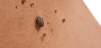 image of a skin tag Ashbourne