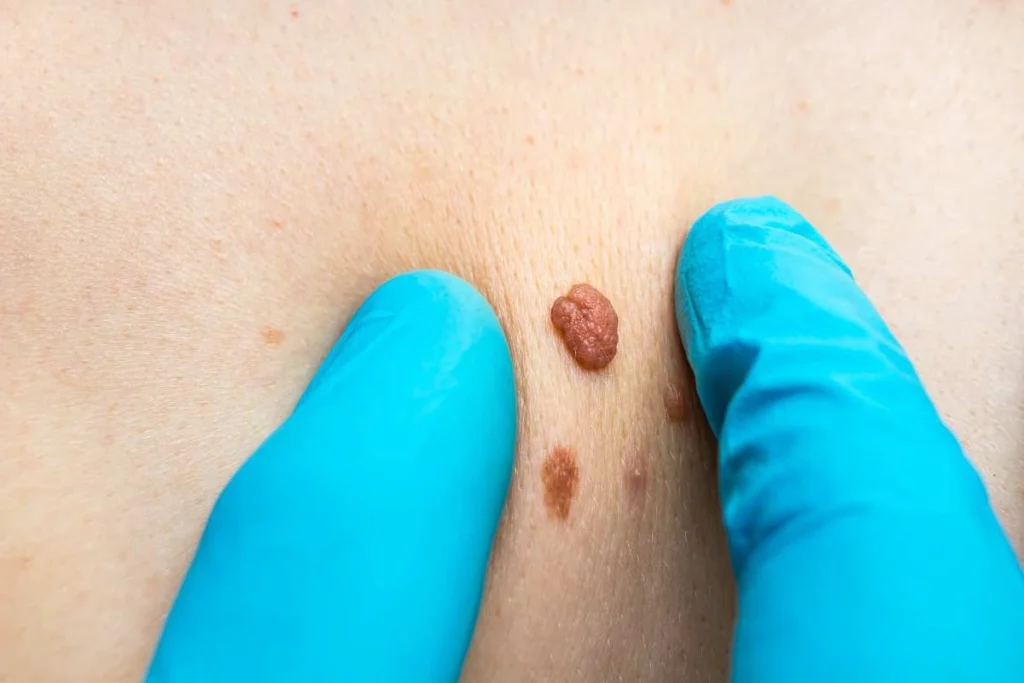Consultant examining a skin tag Ashbourne
