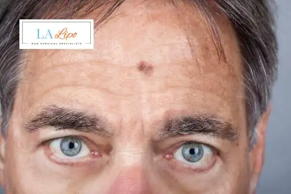 Solar Lentigo Removal Ashbourne image of man with mark on his forehead