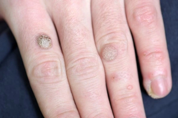 photo of warts on person hand - see wart removal Ashbourne from LA LIPO
