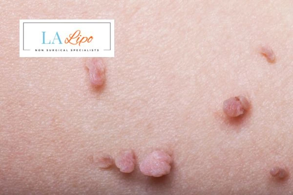 Does cryopen skin tag removal Ashbourne hurt? Find out now call our team today!