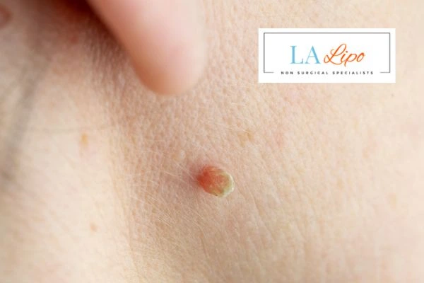 Book skin tag removal Ashbourne today speak to our team now!