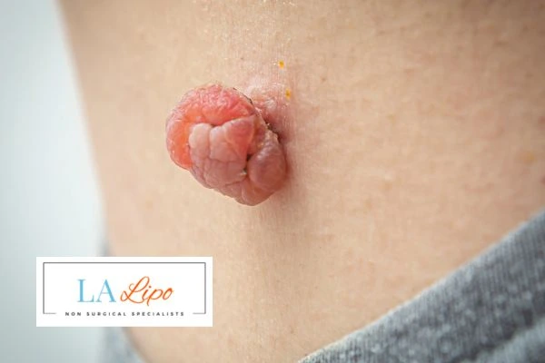 Interested in skin tag removal Ashbourne? Concerned about the pain? Find out more today!