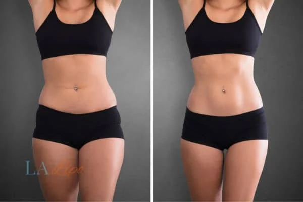 before and after results of non-surgical treatment to help a woman's body image and mental health Ashbourne