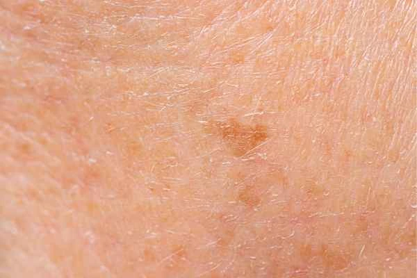close up picture of age spots Ashbourne